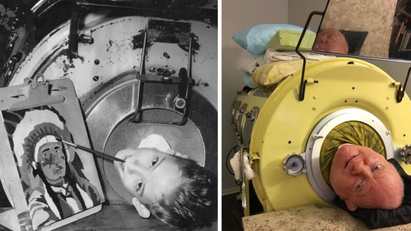 Muere a los 78 años el hombre que habitaba en un ‘pulmón de hierro’