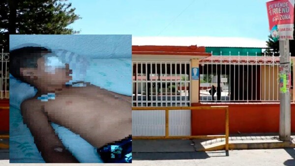 Niño es atacado por compañero de primaria en Hidalgo y pierde un ojo