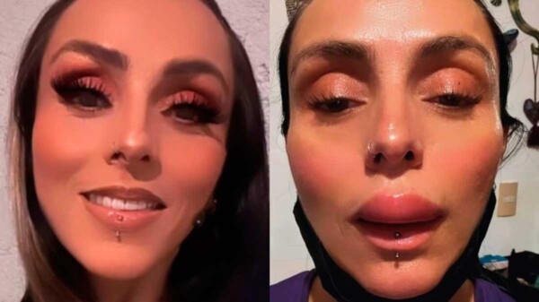 Ivonne Montero aparece con el labio inflamado en redes sociales