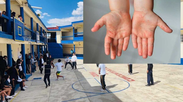 Preocupa brote de virus coxsackie en escuela de Hidalgo