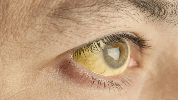 Brinda IMSS-Bienestar atención y tratamiento gratuito a pacientes con diagnóstico de hepatitis