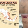 Viruela del Mono en México, estados con más casos