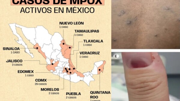 Viruela del Mono en México, estados con más casos