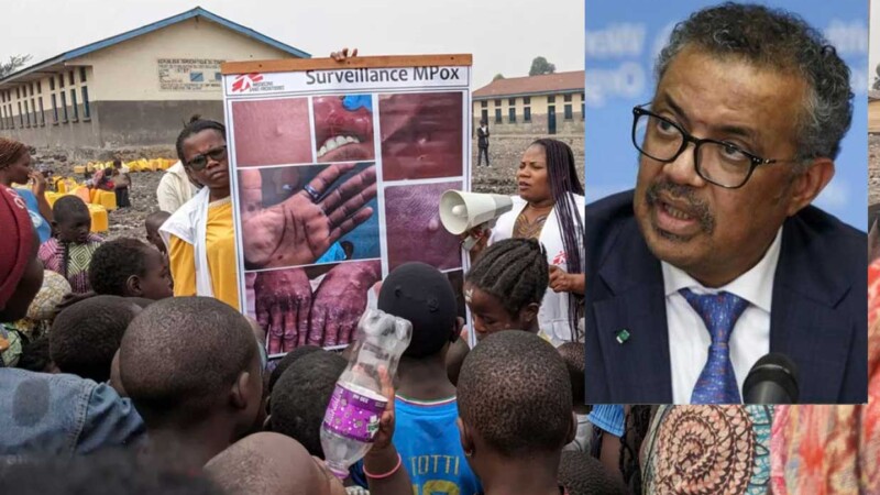 OMS solicita 135 MDD para contener brotes de viruela del mono