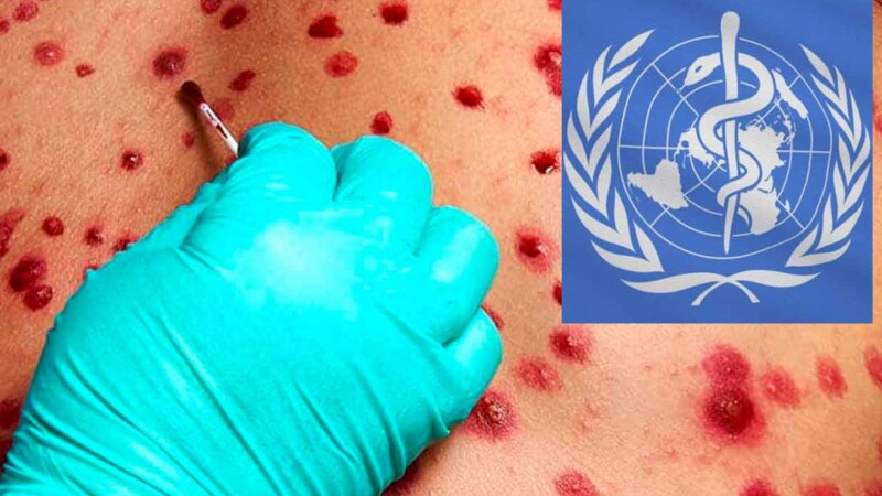 Declara OMS nueva emergencia internacional por viruela del mono
