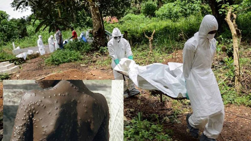 Viruela del Mono ha matado ya a mas de mil personas en África