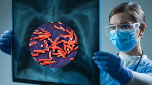 Mueren dos personas por brote de tuberculosis en EE.UU.