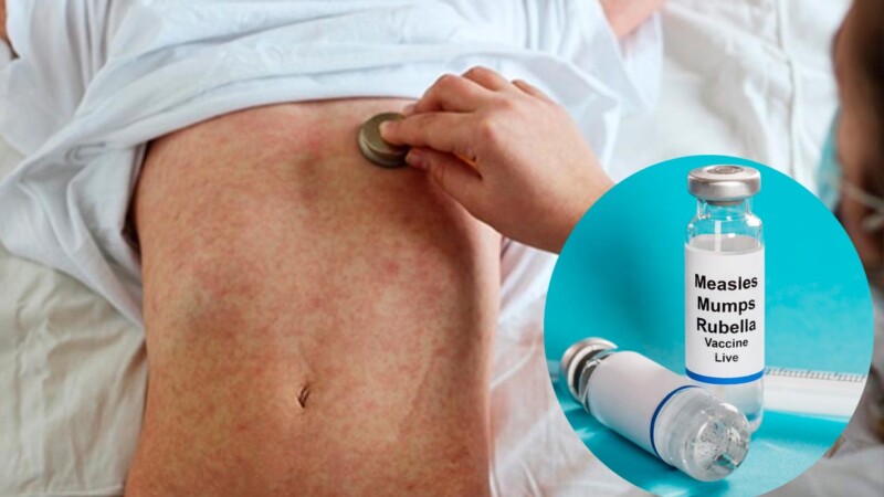 Brote de sarampión asola a Texas, se registran 58 casos