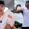 Influencer Gero Arias sufre grave accidente y pierde dos dedos