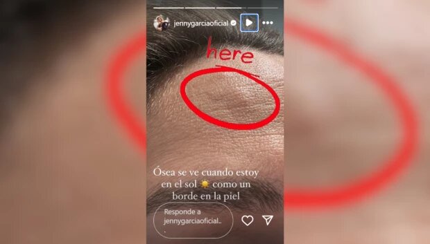 Jenny García revela que tiene un tumor en la frente