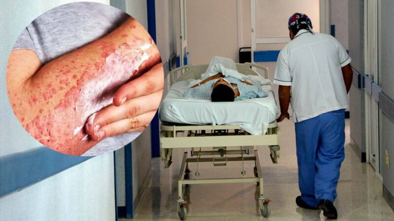 Registra México primer muerto por brote de sarampión