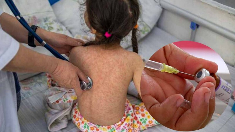 Se dispara brote de sarampión en México con casi dos mil casos