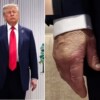 Trump presenta insuficiencia venosa crónica y hematomas