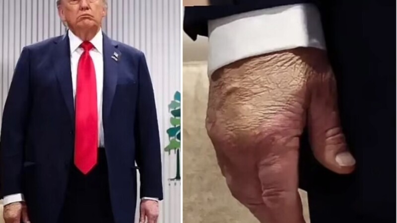 Trump presenta insuficiencia venosa crónica y hematomas