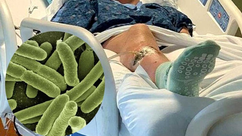 Alerta en Florida por peligrosa bacteria carnivora que ya suma 4 muertes