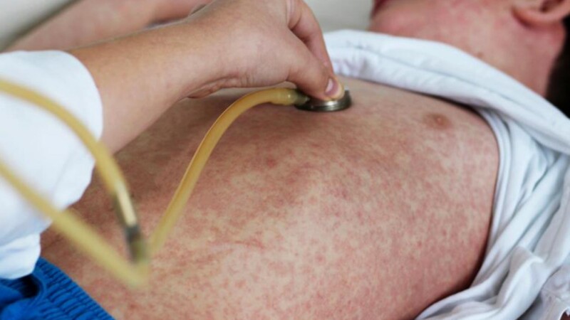 Brote de sarampión en México incrementa numero de muertos a 17