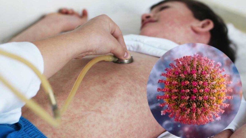 Sarampión se extiende ya a 25 estados en México, hay 22 muertes