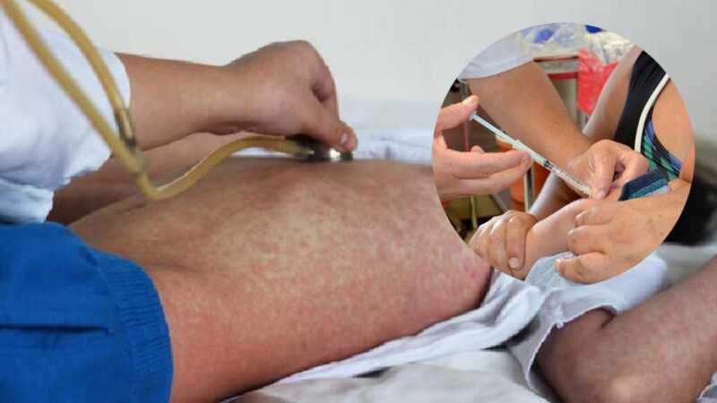 Sarampión ya está en todo México con más de siete mil casos acumulados